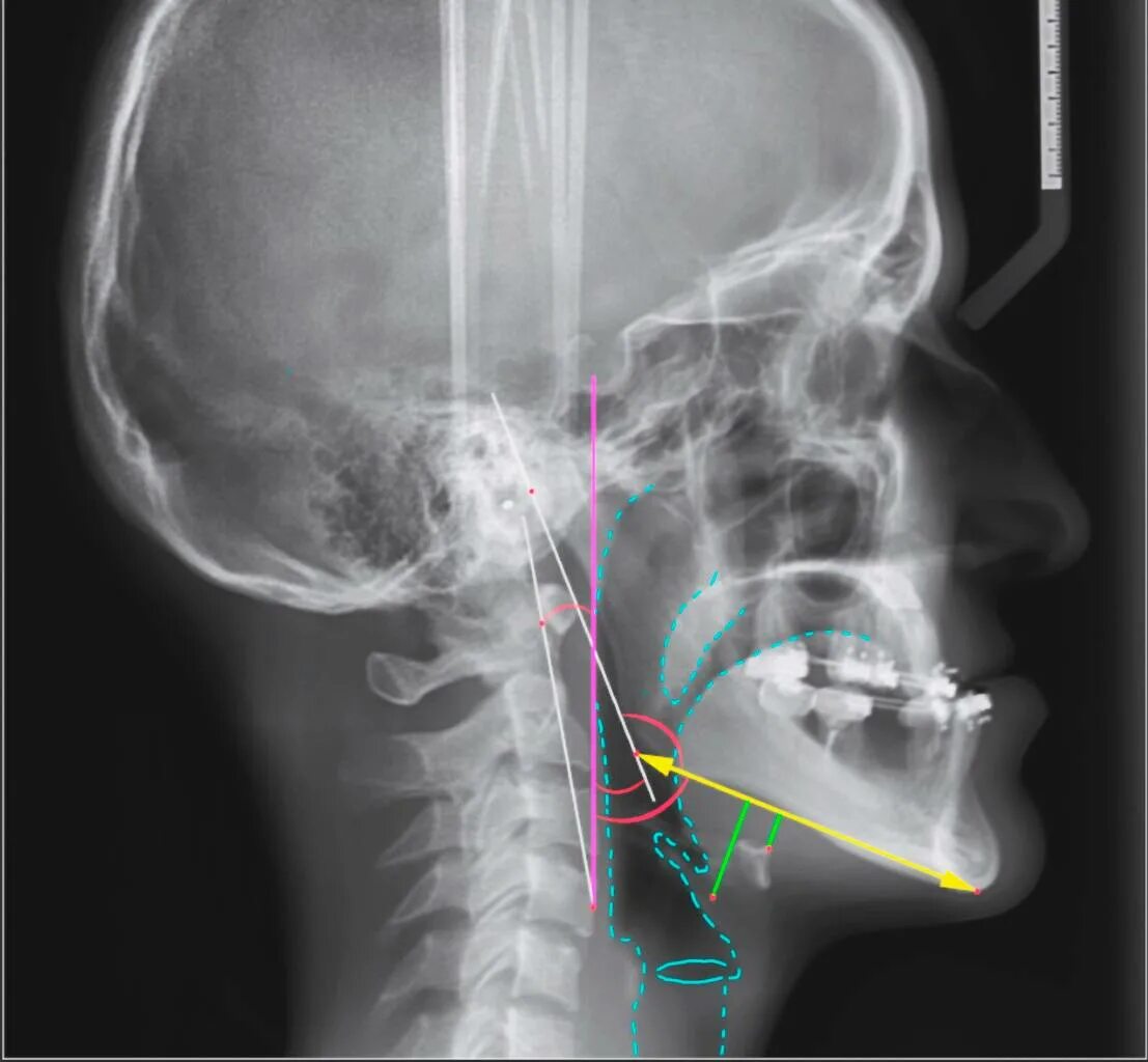 Легкие на кт. Компьютерная томография легких. Скт органов грудной клетки. Интерстициальная эмфизема. Кт дыхательных путей.