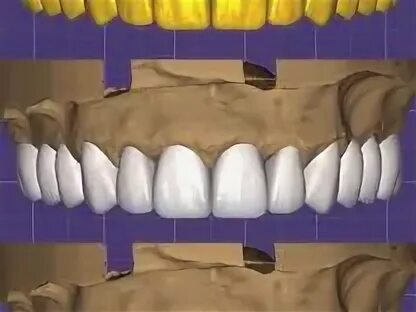 Cad cam моделирование. Фото exocad.
