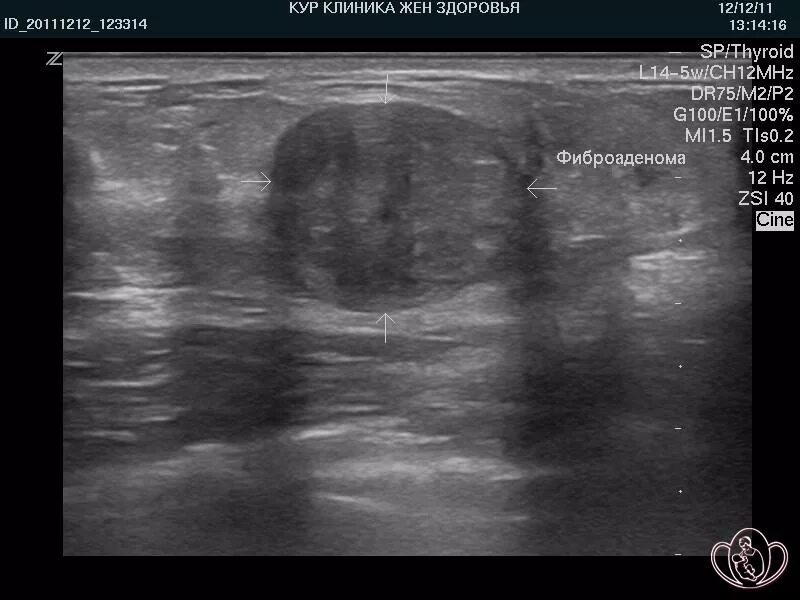 Фиброма в груди. Фиброаденома мол жел УЗИ. Фиброаденома молочной железы УЗД. Листовидная фиброаденома молочной железы на УЗИ.