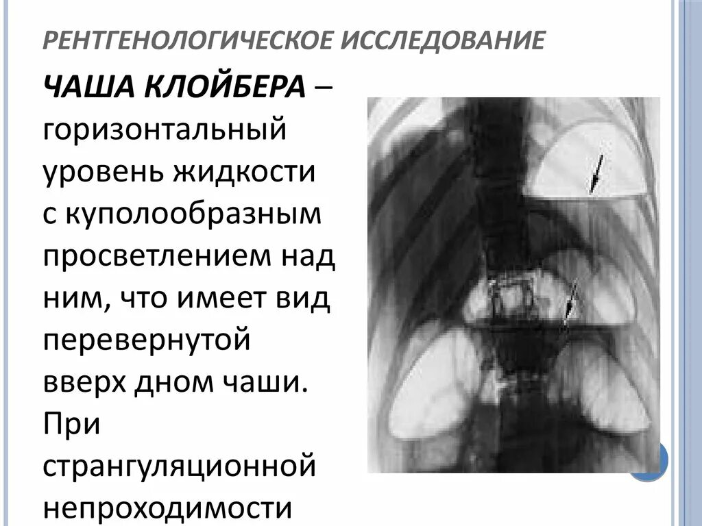 Уровень на рентгене. Уровень на рентгене