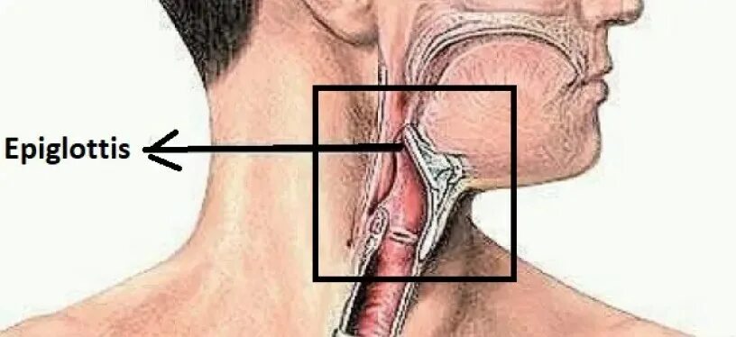Эпиглоттит симптомы. Надгортанник при эпиглоттите. Этиология эпиглоттита.