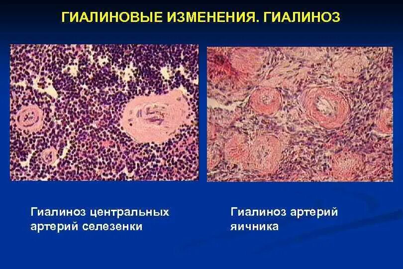 Гиалиноз патоморфология. Гиалиново-капельная дистрофия эпителия канальцев почки. Гиалиноз стенки сосуда микропрепарат. Лентовидная дистрофия. Гиалиновая дистрофия.