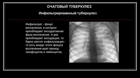 Острый очаговый туберкулез