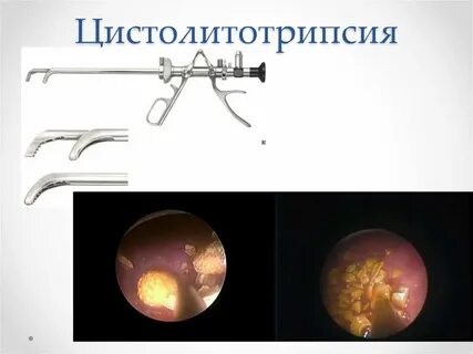 Операция удаление камней из мочевого