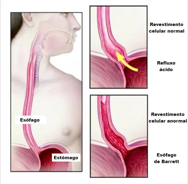 Пищевод Барретта эндоскопия. Баретта пищевод Барретта что это. Пищевод б