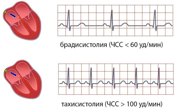 Тахисистолия это