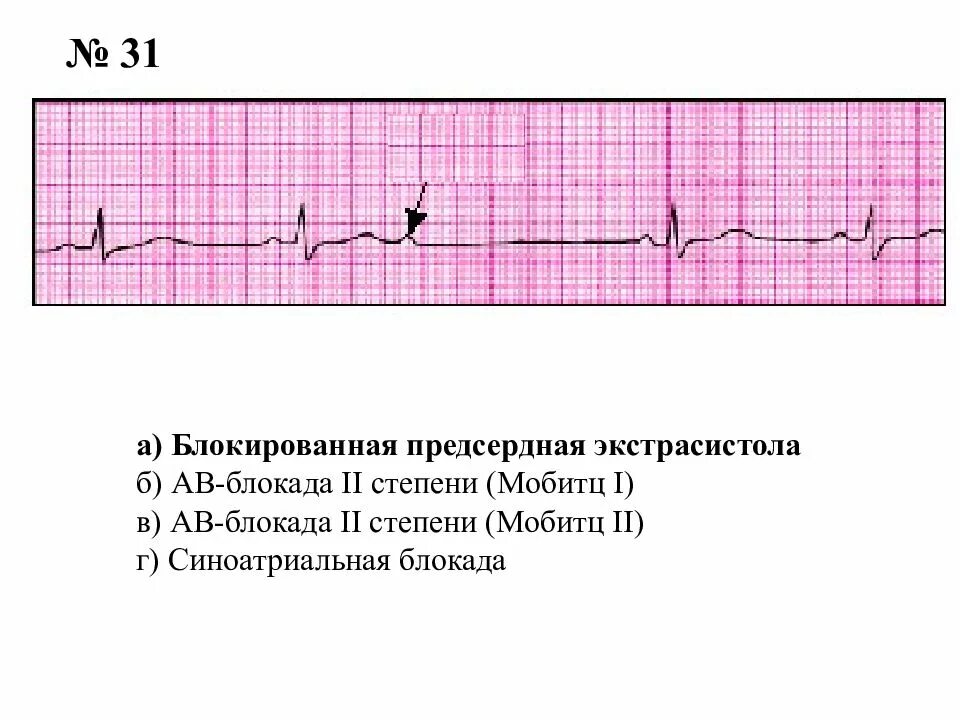 Предсердная блокада. АВ блокада II степени Тип Мобитц II. АВ-блокады II степени II типа (Мобитц II),. АВ блокада 2-й степени, Мобитц-1. АВ блокада 2 степени Мобитц 3.