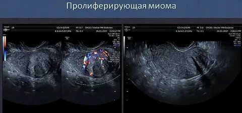 День цикла узи миома