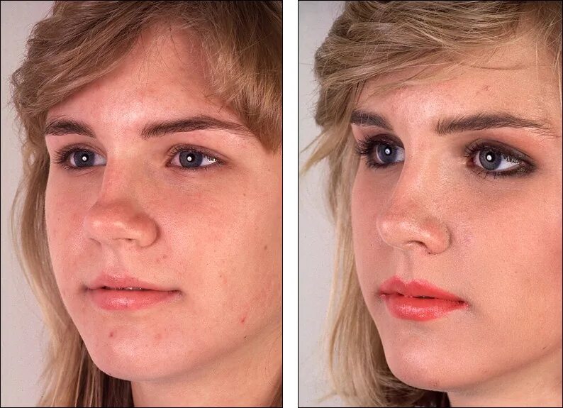 Ринопластика горбинки носа. Носовая перегородка анатомия строение. Бейби нос ринопластика. Покажи как выглядит нос. Ринопластика курносый.