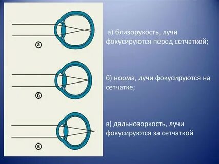 Установите соответствие изображение фокусируется перед сетчаткой