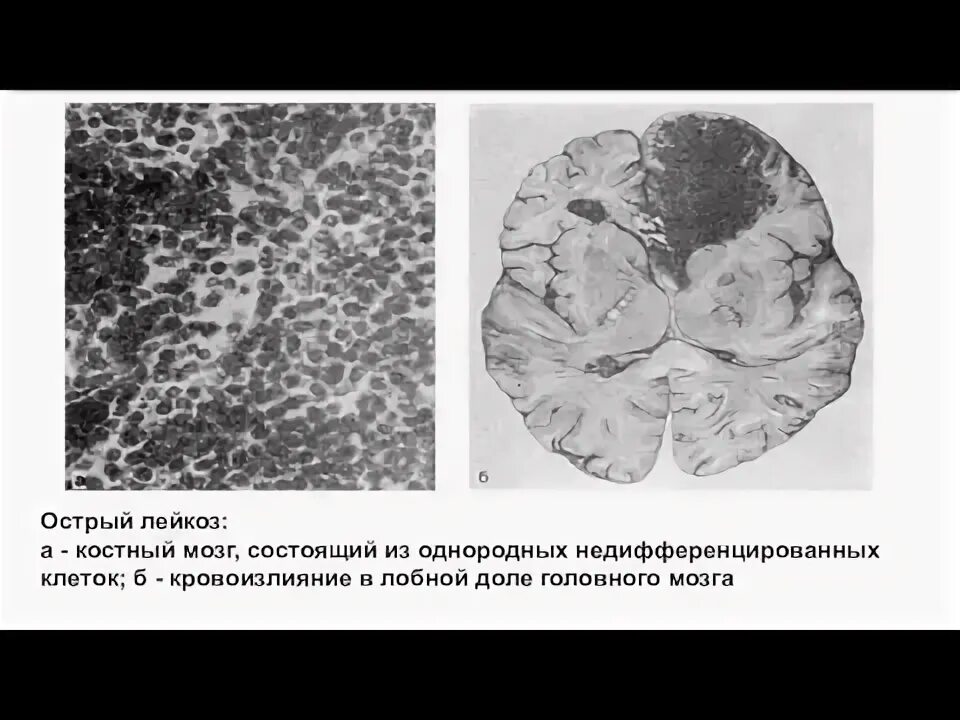 Недифференцированный лейкоз. Недифференцированный лейкоз