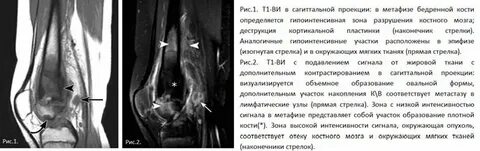 Инфаркт костного мозга мрт