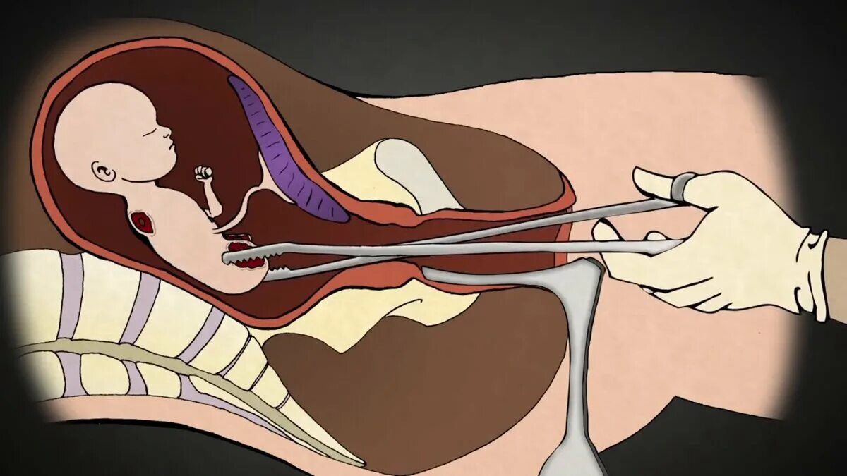 Замершая беременность операция. Хирургический аборт на поздних сроках. Инструментальный аборт. Искусственное прерывание родов.