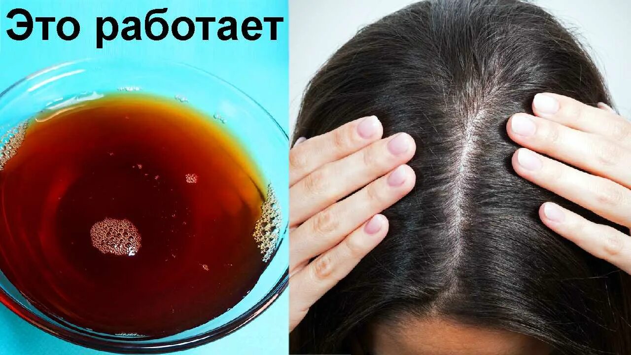 Как быстрее избавиться от перхоти. Народные средства от перхоти на голове. методы избавления от перхоти. избавление от перхоти в домашних. народные средства от перхоти в домашних.