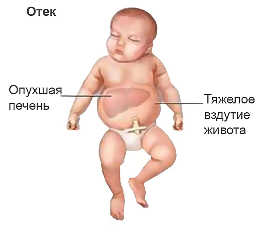Симптомы печени у ребенка. Отечная форма гемолитической болезни плода. Гемолитическая болезнь новорожденного отечная форма. Отечная форма при гемолитической болезни новорожденных. Отечная форма гемолитической болезни новорожденных фото.