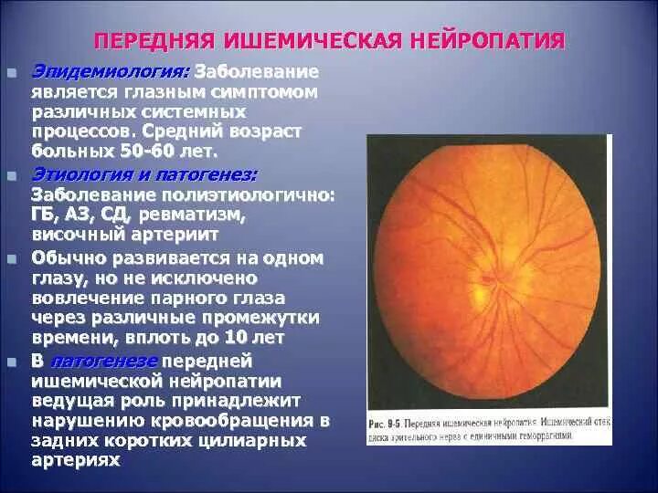 Нейропатия диска зрительного нерва. Ишемическая нейропатия глазное дно. Ишемическая нейропатия зрительного нерва. Оптиконейропатия зрительного нерва. Передняя ишемическая оптиконейропатия зрительный нерв.