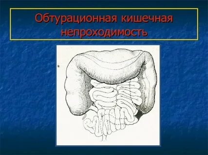 Острая обтурационная толстокишечная непроходимость