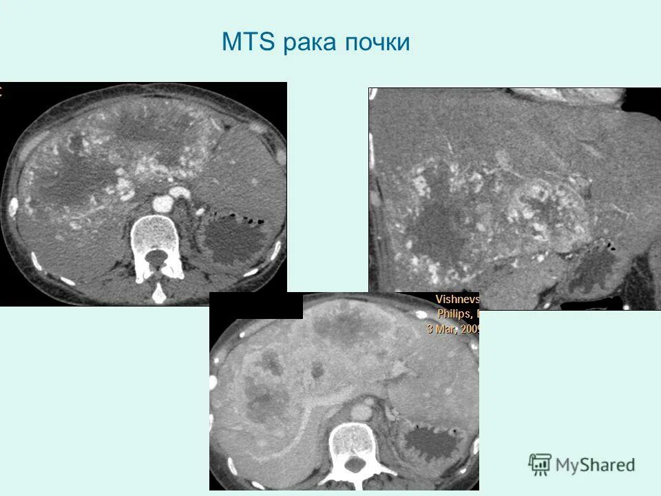 Mts поражение печени