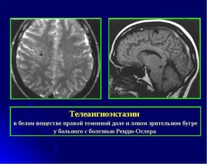 Белое вещество теменных долей