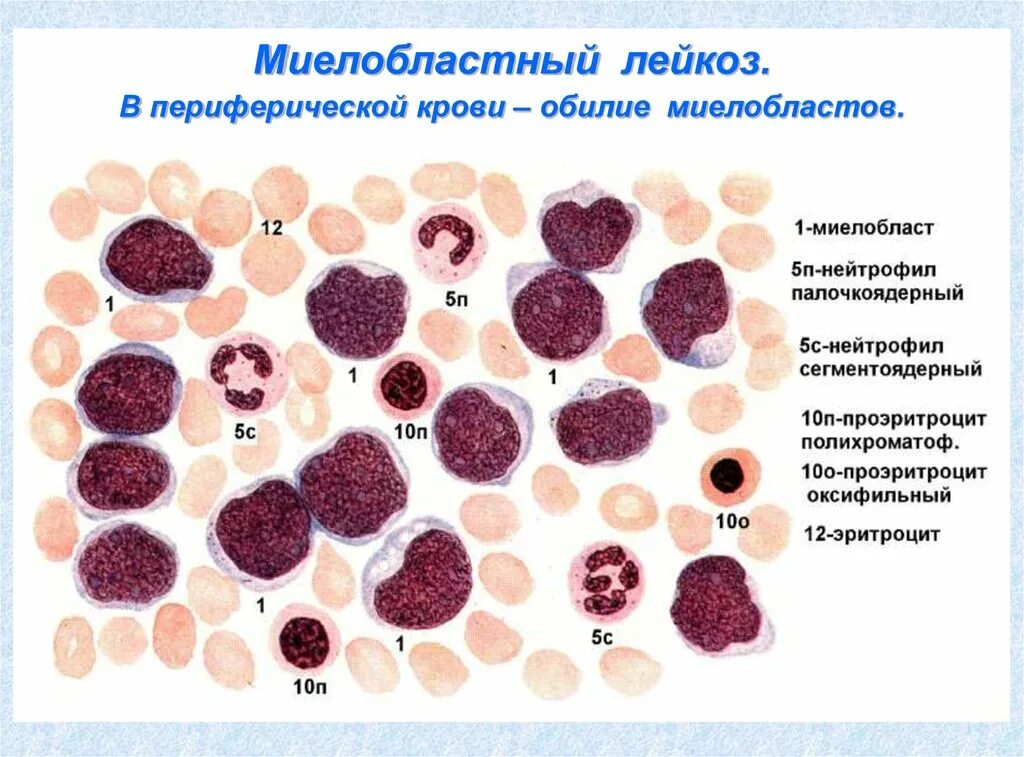Болезнь миелолейкоз
