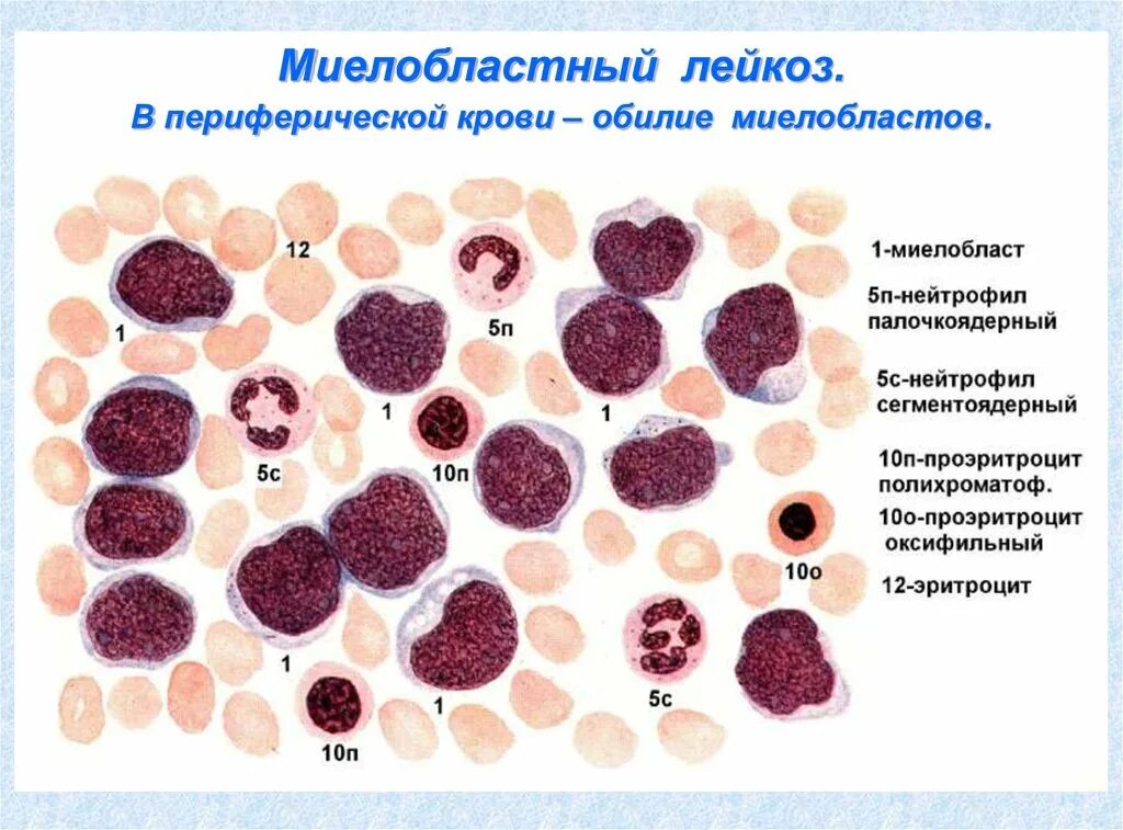 Острый миелобластный лейкоз картина крови патофизиология. Острый миелобластный лейкоз гистология. Острый миелобластный лейкоз картина крови этиология патогенез. Хронический миелоидный лейкоз картина крови. Лейкоз характеризуется