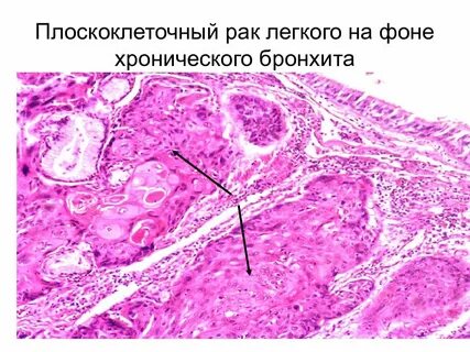 Метастазы плоскоклеточного