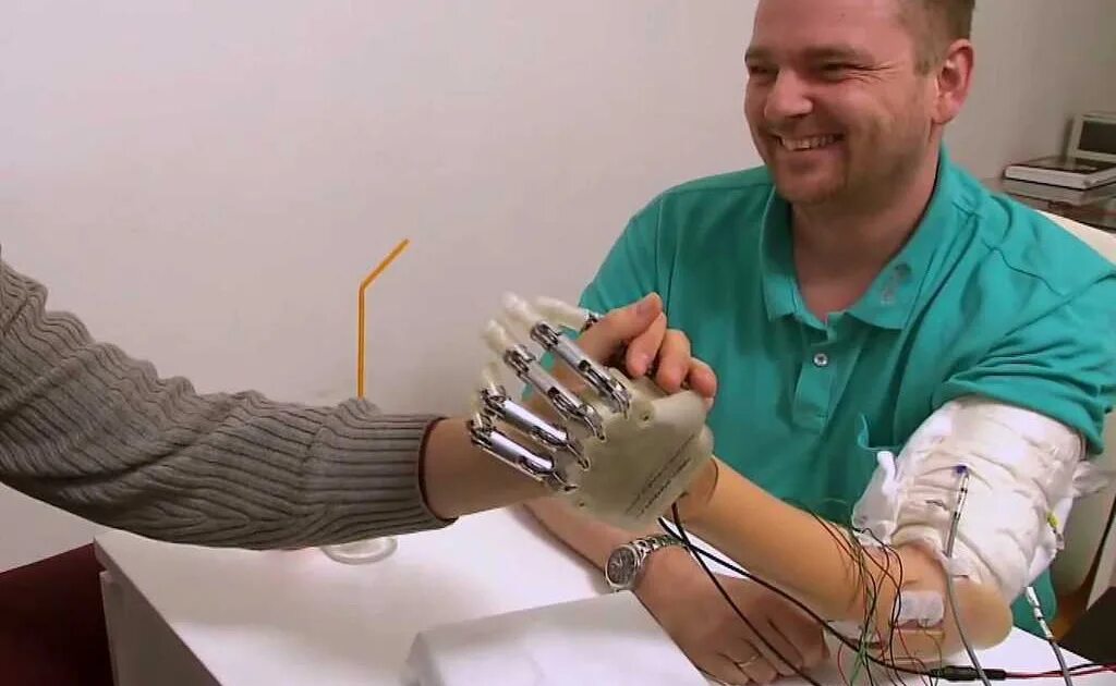 Бионические протезы верхних конечностей. Биоэлектрический протез руки. Протез кисти Квантум. Современные протезы рук.