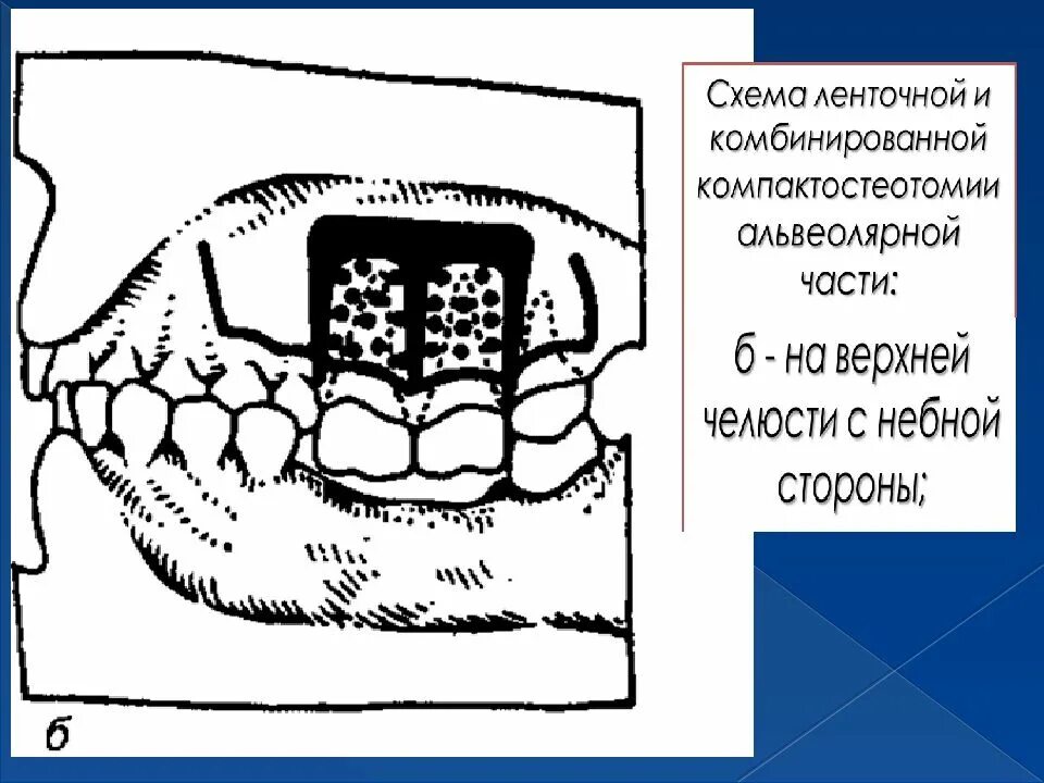 Классификация деформаций зубных рядов. Вторичные деформации зубных рядов. деформация зубных рядов презентация. вторичной деформации зубных рядов зубов. вторичные деформации зубных рядов при пародонтите.