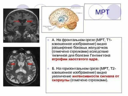 Расширение боковых желудочков