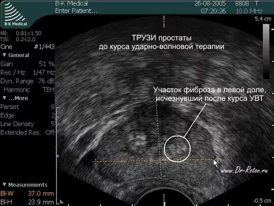 Простата осина. Предстательная железа анатомия зоны УЗИ. Хронический калькулезный простатит УЗИ. Ультразвуковая анатомия предстательной железы. Предстательная железа аденома на УЗИ зоны.