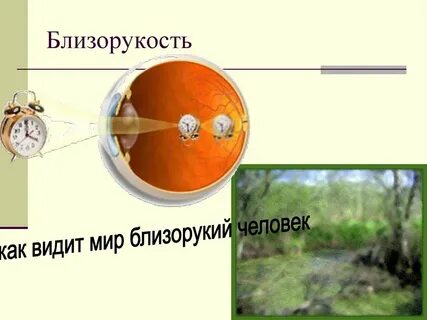 Как видит человек с миопией