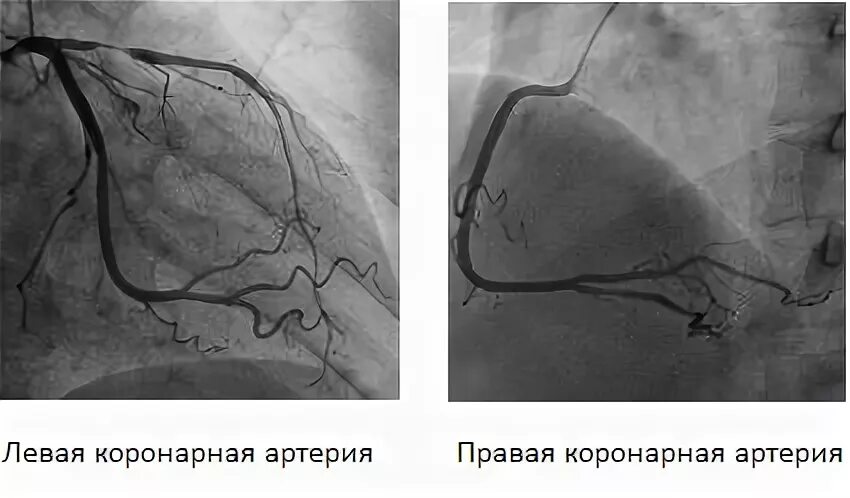 Сужение правой артерии. Коронарография стеноз ПМЖВ. Коронарография анатомия. Анатомия коронарных артерий коронарография. Стентирование устья ПМЖВ.