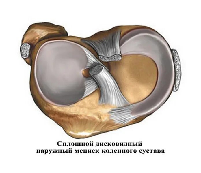 Повреждение мениска коленного сустава. Наружный мениск коленного сустава. Задний Рог медиального мениска. Дисковидный латеральный мениск.