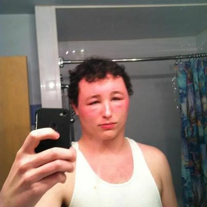 Человек укус пчелы. Человек укус пчелы. Человек укус пчелы. Человек укус пчелы. Человек укус пчелы.