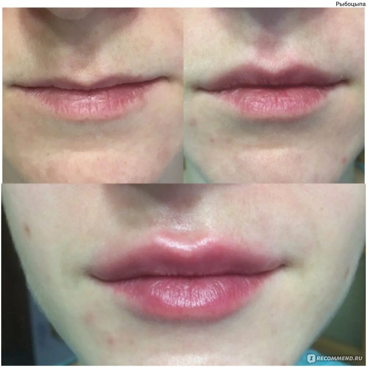 Губы после ювидерм. Juvederm 1 мл увеличение губ. препарат ювидерм 3 для увеличения губ. филлер для губ ювидерм 1 мл.
