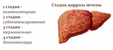Развитие цирроза печени