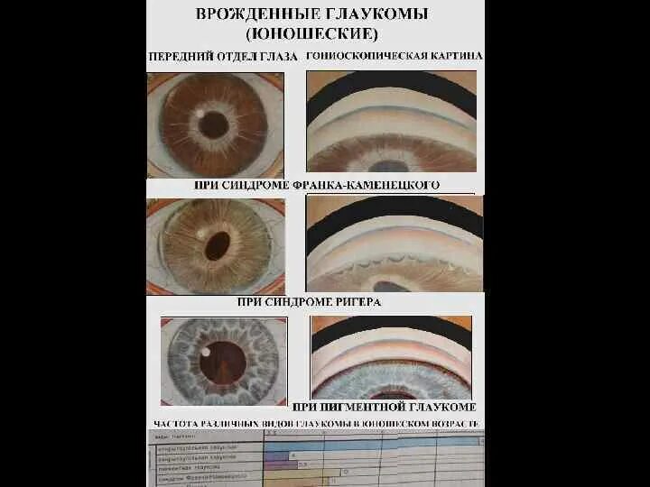 Врожденная глаукома гониоскопия. Классификация глаукомы офтальмология. Классификация угла передней камеры глаза. Вторичная врожденная глаукома. Классификация глаукомы