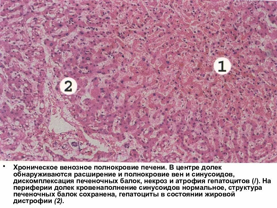 Печень микропрепарат описание. Хроническое венозное полнокровие печени. Острое венозное полнокровие печени гистология. Венозное полнокровие печени микропрепарат. Мускатный цирроз печени микропрепарат.