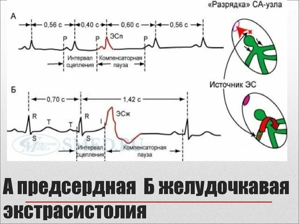 Сколько экстрасистол норма