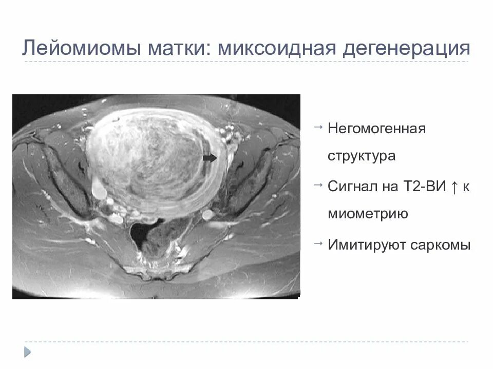 Миксоидная дегенерация миомы. Миксоидная дегенерация лейомиомы матки мрт. Гиалиновая дегенерация миомы. Миксоидная дегенерация миомы на мрт. Мрт эндометрия