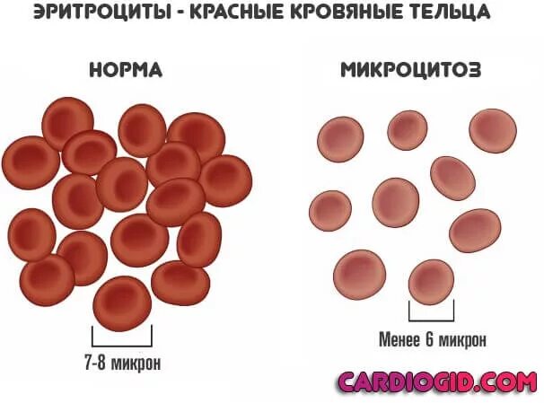 Анемия гипохромия микроцитоз. Микроцитоз эритроцитов причины. Макроциты и микроциты. Эритроциты при макроцитарной анемии.