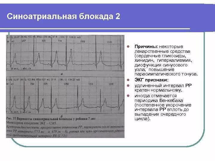 Блокада узла. Синоатриальная блокада степени на ЭКГ. Блокада са узла ЭКГ. Синоатриальная блокада 2 степени на ЭКГ. Синоатриальная блокада 2 ст аритмия детей.