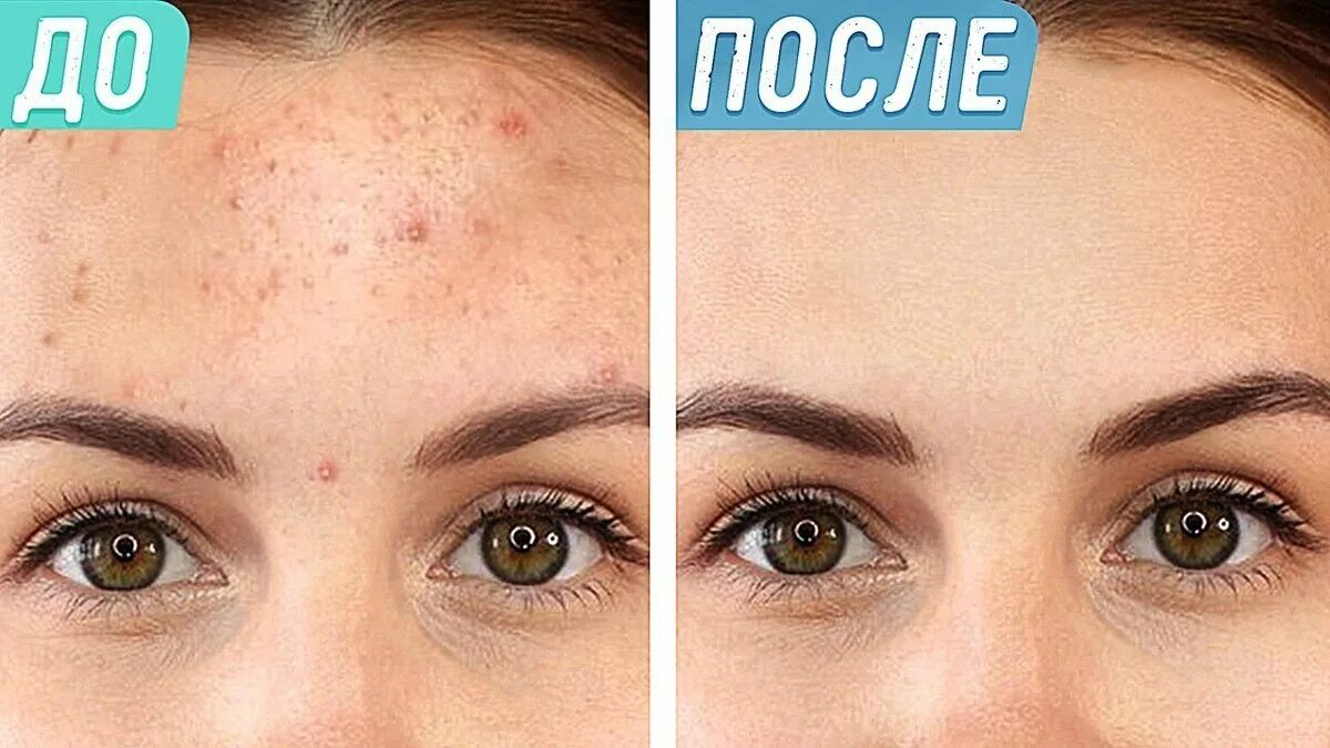 Избавится эффективно от прыщей. Какизбавится от прыщей. избавление от прыщей на лице. как избавиться от прыщей на лице. как избавиться от парши.
