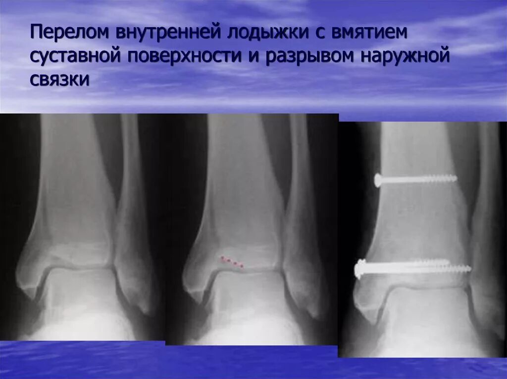 Трещина наружной. Лодыжки перелом перелом лодыжки. Перелом наружной лодыжки рентген. Внутрисуставные переломы голеностопного сустава рентген. Перелом метафиза наружной лодыжки.