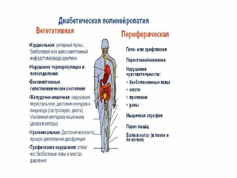 Полинейропатия при сахарном диабете 2 типа