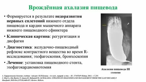 Ахалазия пищевода