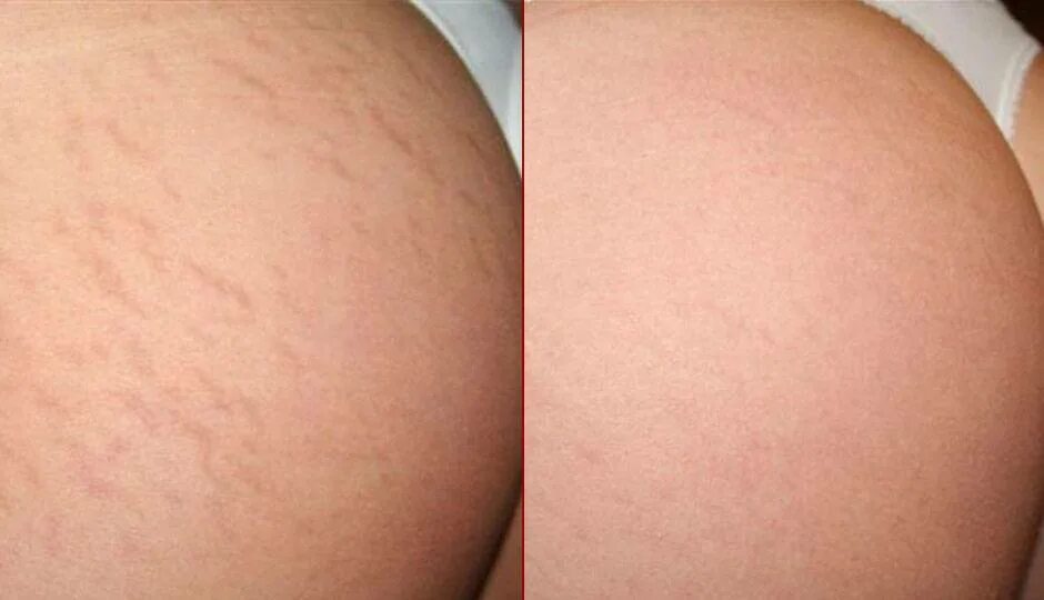 Почему растяжки на бедрах. Стрии на бедрах и ягодицах. Растяжки светлые на бедрах. Почему растяжки на бедрах. Почему растяжки на бедрах.