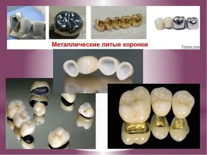 Виды искусственных коронок