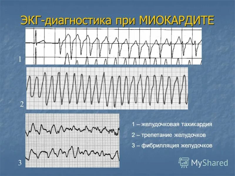 Фибрилляция предсердий тахикардия желудочков. Фибрилляция желудочков на экг. трепетание желудочков и желудочковая тахикардия. фибрилляция желудочков и трепетание желудочков. купирование фибрилляции желудочков.