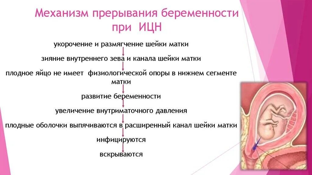 ИЦН клинические проявления. Матка при беременности.